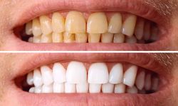 Beyaz dişlere kavuşmanın doğal yolları: Diş taşından kurtulun!