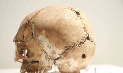 Dünyanın ilk beyin ameliyatına ait kafatası